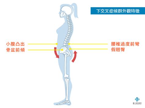 女生屁股翹|「屁股翹」其實是腰痛、脊椎滑脫警訊？慈濟醫師教。